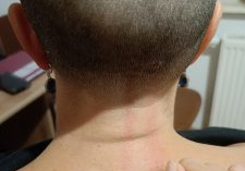 ogolona głowa, klawiterapia